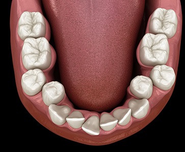 Illustration of crowded teeth