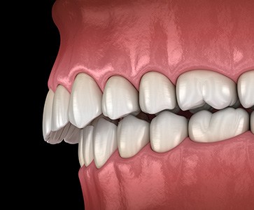 Illustration of an overbite