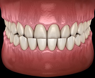 Illustration of an underbite