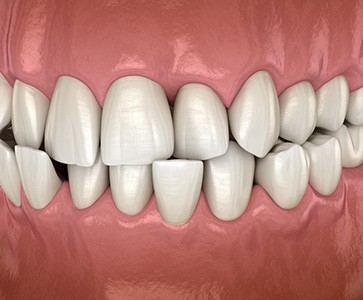 Illustration of a crossbite