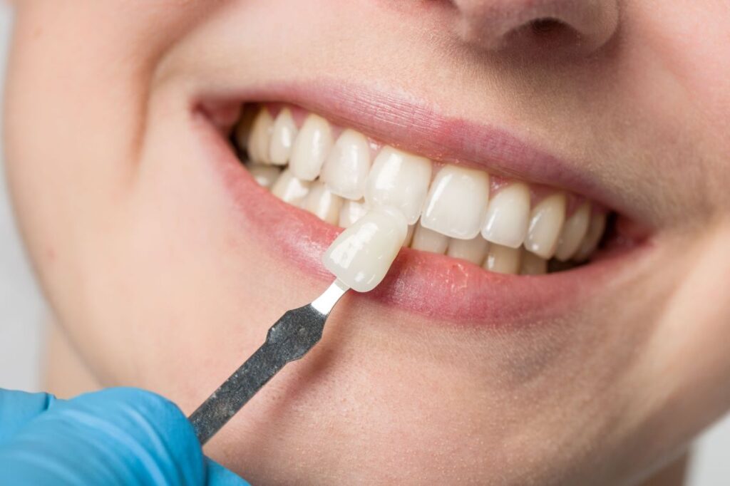 A closeup of a woman’s smile being treated with porcelain veneers